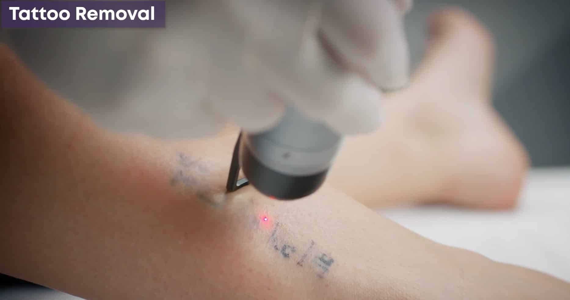 Tattoo Removal Services Near Me